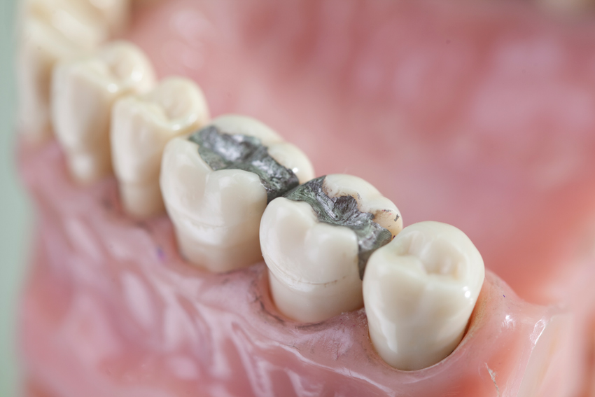 Amalgam-Füllung Detailansicht Amalgam-Füllung Zahnarztpraxis Otten Osnabrück