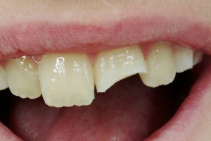Zahn abgebrochen stück Zähne kleben