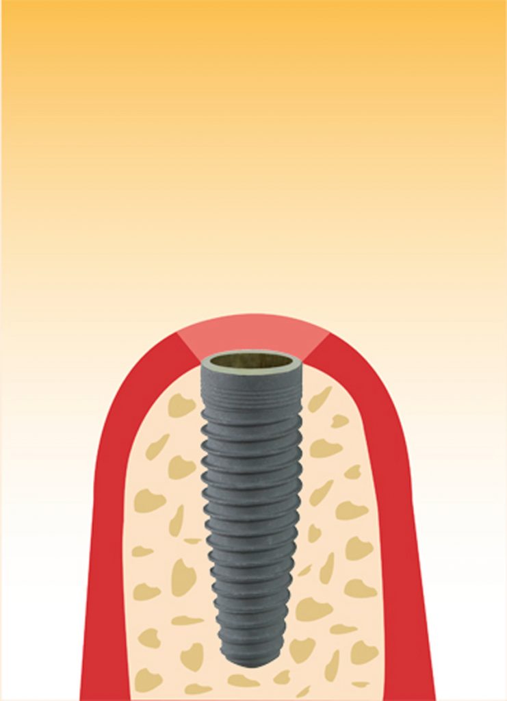 Illustration Implantat Technik