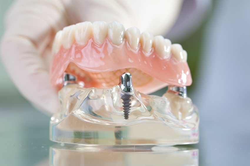 Prothese Implantatgetragen-9377 Prothese Implantatgetragen