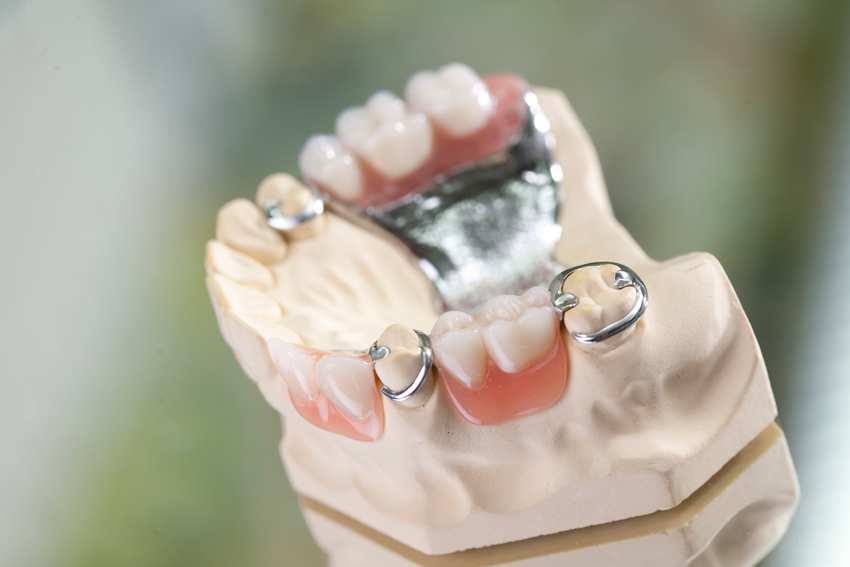 klammermodellguß-9386 Teilprothese
