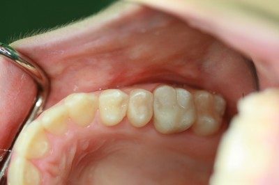 Kompositfüllung: Infos zur Zahnfüllung aus Kunststoff
