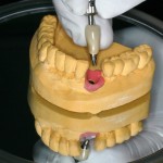 Einzelimplantat Implantat