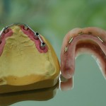 Implantatgetragene-Prothese-2
