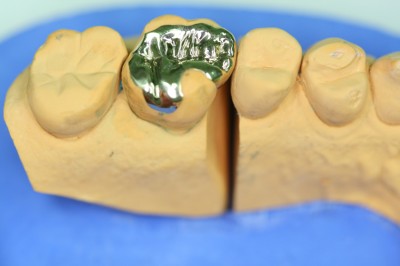 gold-inlay-IMG_5548-400x266 Goldinlay