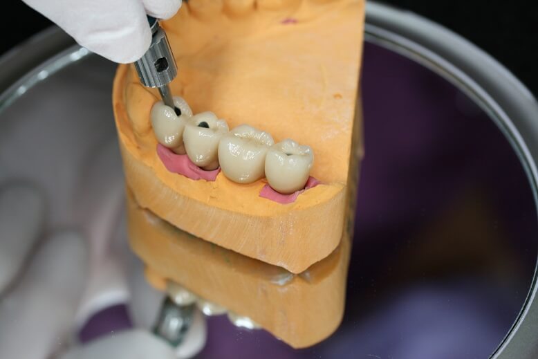 Festschrauben-implantatgetragene-Brücke