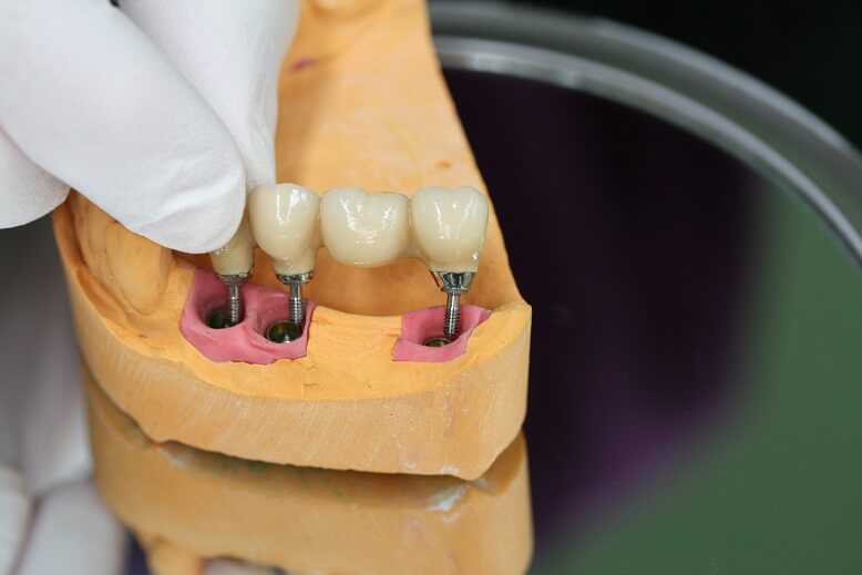 Implantatgetragene-Brücke auf Modell