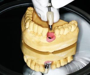 Einzelimplantat Implantatversorgung
