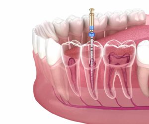 Endodontie Wurzelbehandlung